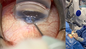 Surgical Technique: Via360 Inferior Hemi-GATT