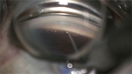 Surgical Video of the iVent Procedure